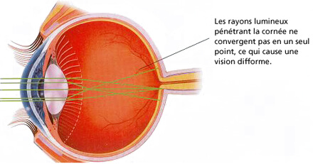 lasik correction vue laser Tunisie