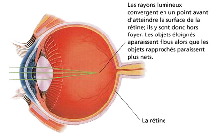 lasik correction vue laser Tunisie