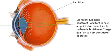 lasik correction vue laser Tunisie