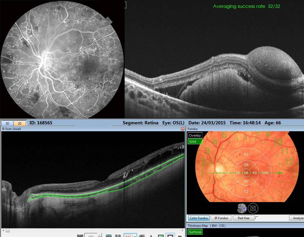 Imagerie oculaire OCT DRI triton lasik Tunisie